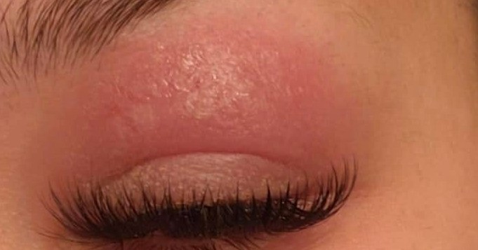 arllergic- Volulme lash extensions- LavisLash