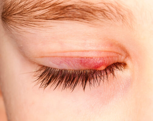 Eye diseases. Closed eye with sty - one bad result of eyelash extensions. LavisLash US