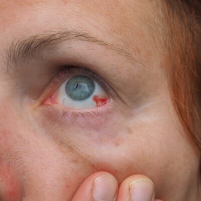  bleeding-hyposhagmus-bleeding-under-eyelash-extension-lash-allergy-lavislash-lavislashus